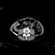 Volvulus of the cecum: CT - Computed tomography